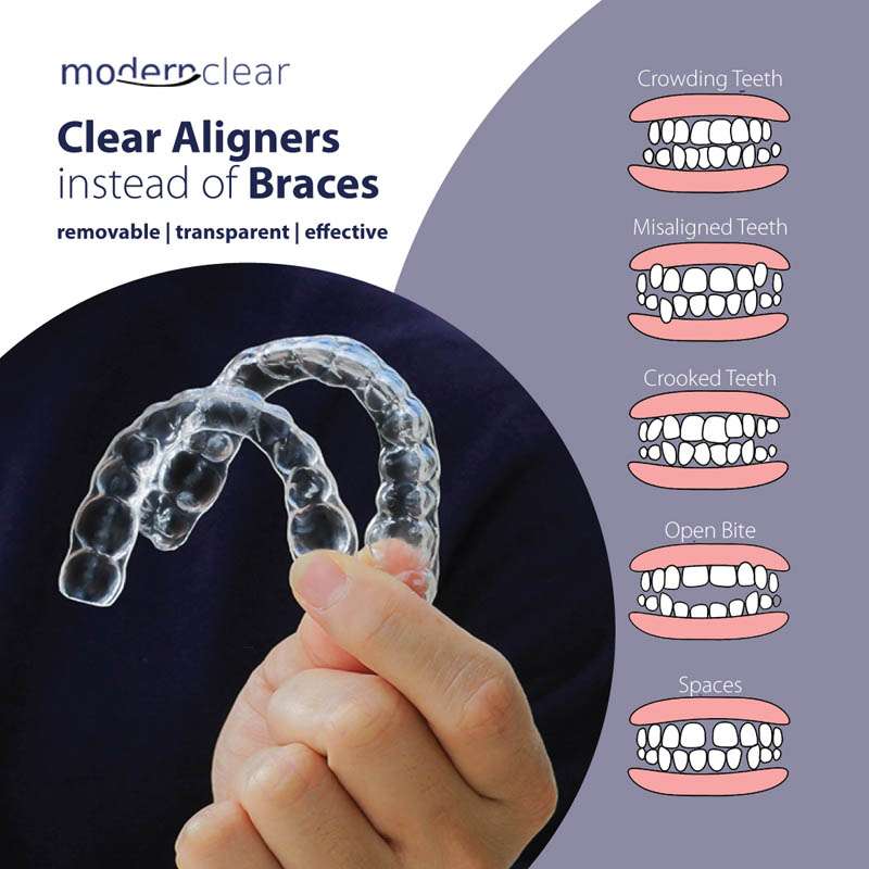 Invisible Aligners A comfortable Orthodontic Option Frederick